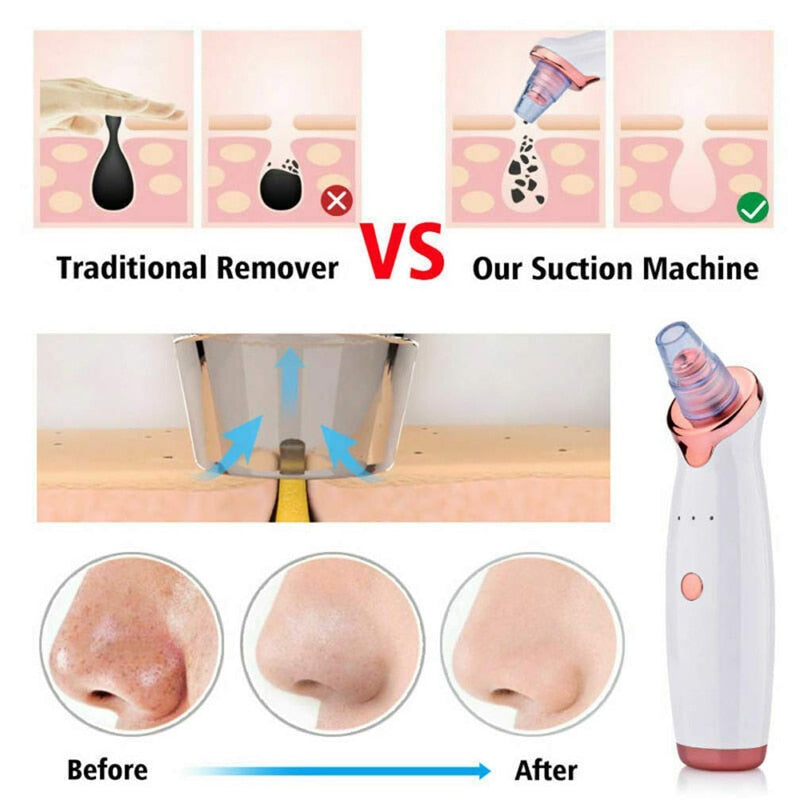 VacBlack - Premium Blackhead Vacuum Remover Set