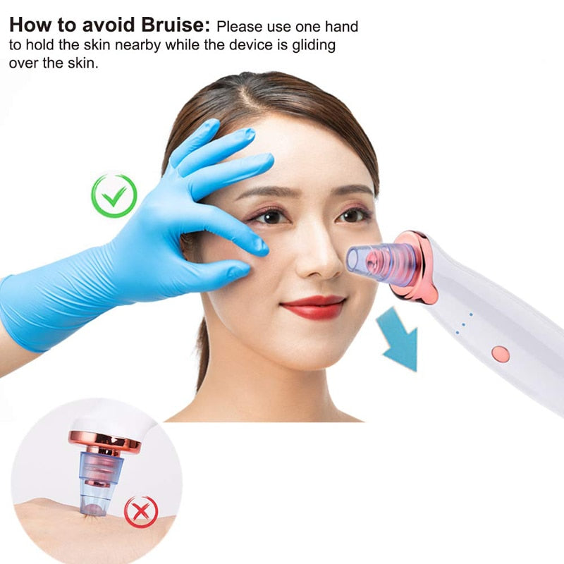 VacBlack - Premium Blackhead Vacuum Remover Set